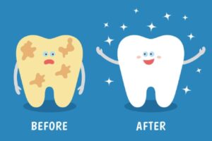 Đánh bóng răng sẽ giúp răng trắng sáng, khỏe mạnh hơn