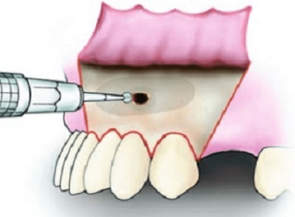 Chóp răng bị viêm nhiễm cần phải loại bỏ