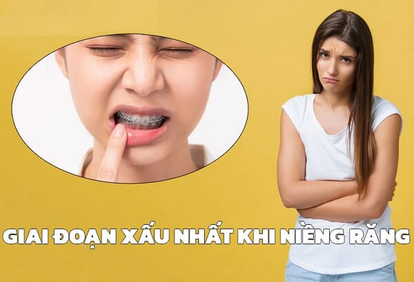 Giai đoạn xấu nhất khi niềng răng là giai đoạn nào?