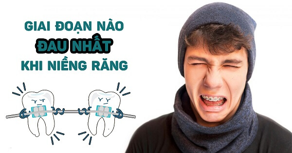 Giai đoạn đau nhất của niềng răng là giai đoạn nào?