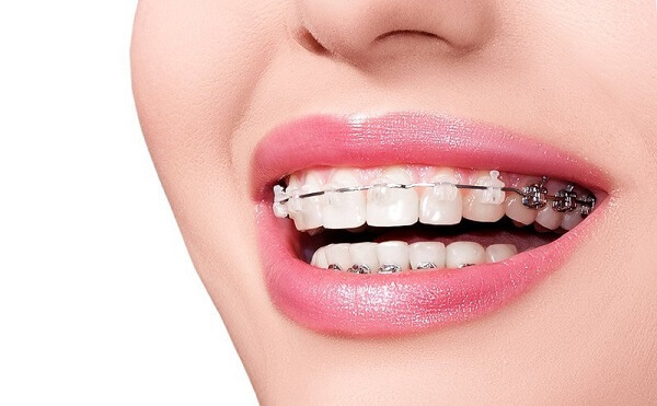 Niềng răng chỉnh nha - Giải pháp giúp sở hữu hàm răng đều đẹp