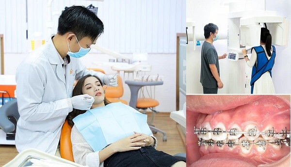 Quy trình niềng răng chỉnh nha tại Nha Khoa City Smiles
