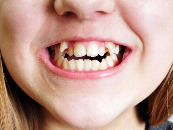 Răng khểnh hay còn gọi là răng nanh, là răng nằm ở vị trí số 3