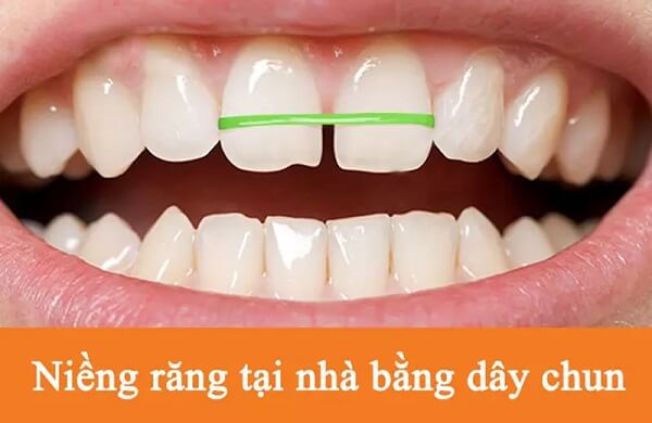 Niềng răng tại nhà là gì? Có hiệu quả không?