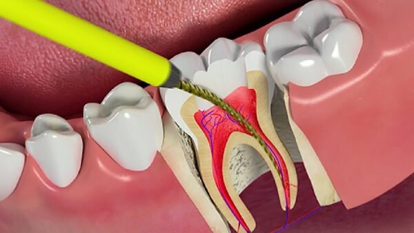 Điều trị nội nha nên được tiến hành sớm để tránh những vấn đề phát sinh