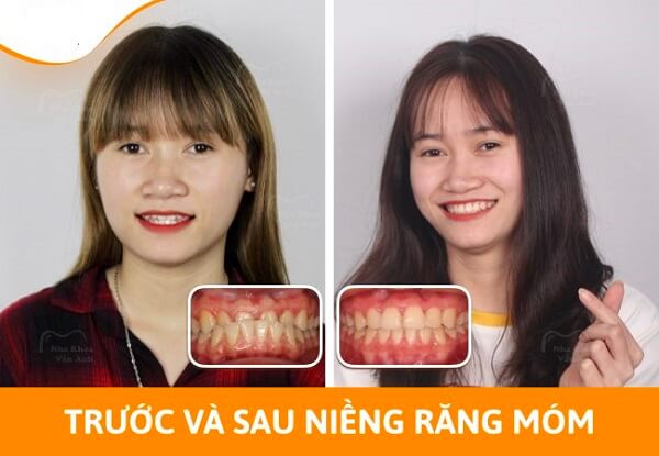 Sự thay đổi khuôn mặt trước và sau khi niềng răng móm