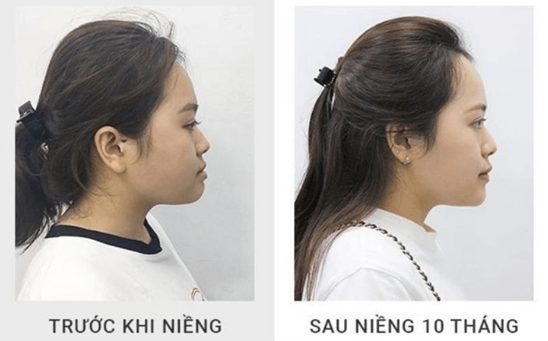 Trước và sau khi niềng răng có làm thay đổi khuôn mặt không?