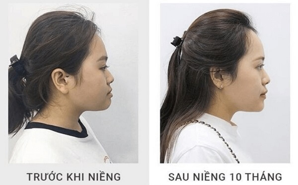 Góc nghiêng trước và sau khi niềng 10 tháng