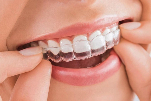 Niềng răng trong suốt invisalign