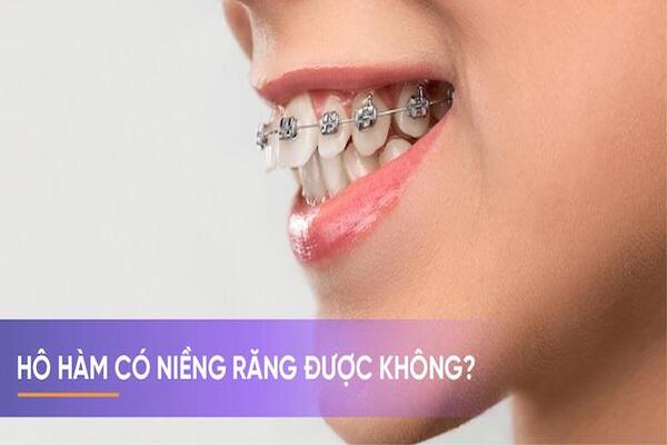 Hô hàm có niềng răng được không