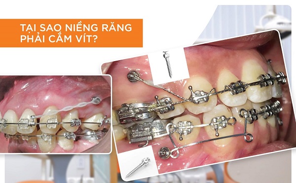 Trường hợp nào nên bắt vít niềng răng?