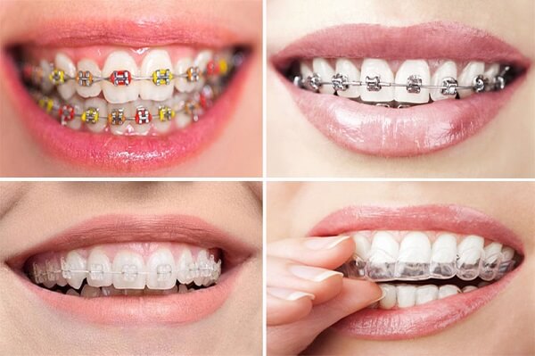 Các loại niềng răng hiện nay