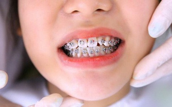 Giai đoạn xấu nhất khi niềng răng là giai đoạn nào? 