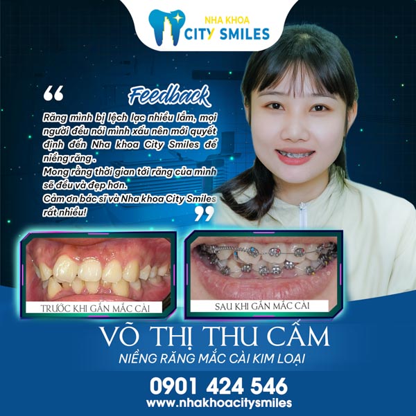 Quy trình niềng răng mắc cài kim loại tại Nha Khoa City Smiles