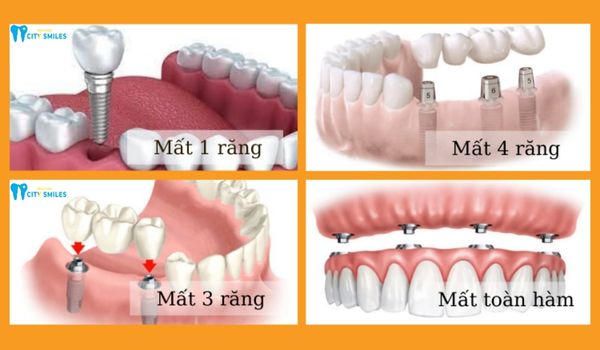 Tùy số lượng răng bị mất mà có cách làm implant tương ứng