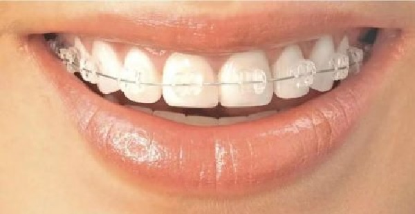Niềng răng 1 hàm sẽ giúp tiết kiệm được thời gian và chi phí điều trị