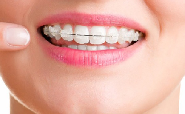 Niềng răng hàm trên hoặc dưới chỉ được thực hiện khi có chỉ định của bác sĩ