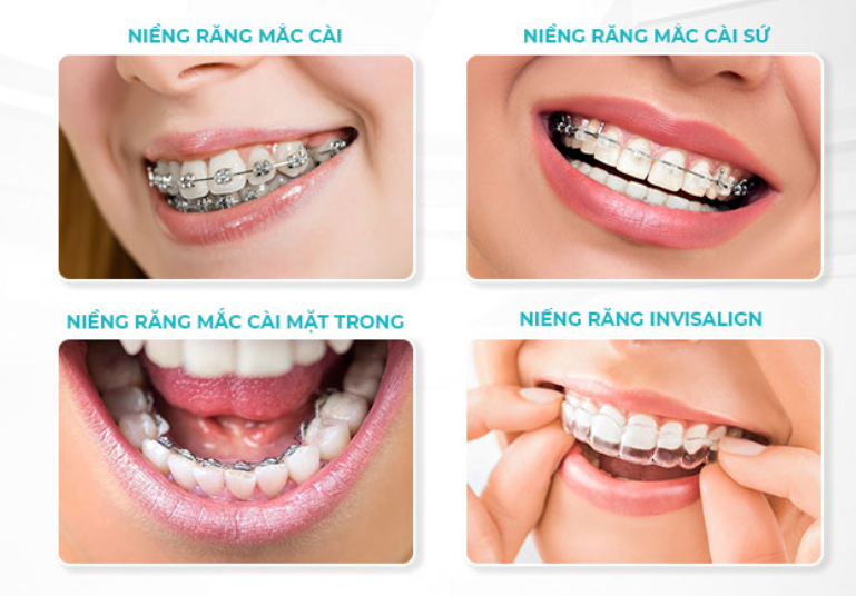 Các phương pháp niềng răng hàm trên phổ biến hiện nay