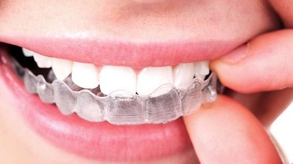 Giai đoạn xấu nhất khi niềng răng? 6 Phương pháp niềng răng không xấu - Niềng răng trong suốt