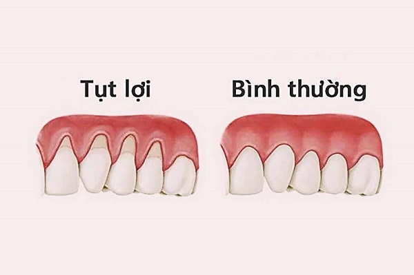 Tụt lợi khi niềng răng: Nguyên nhân và cách khắc phục