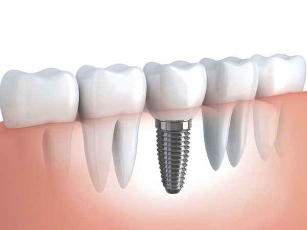 Trụ Implant Osstem