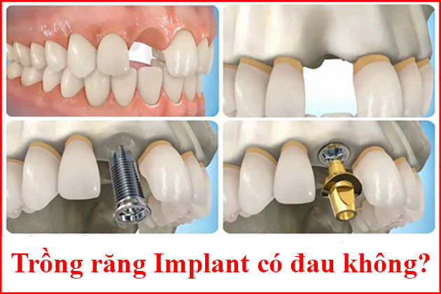 trồng Răng Implant 4