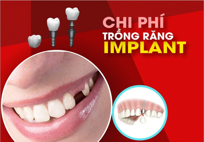 trồng Răng Implant 5