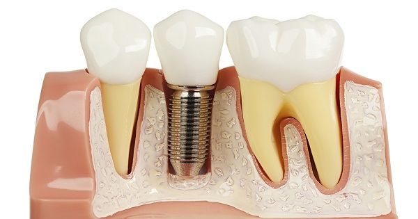 Review trồng răng Implant 2