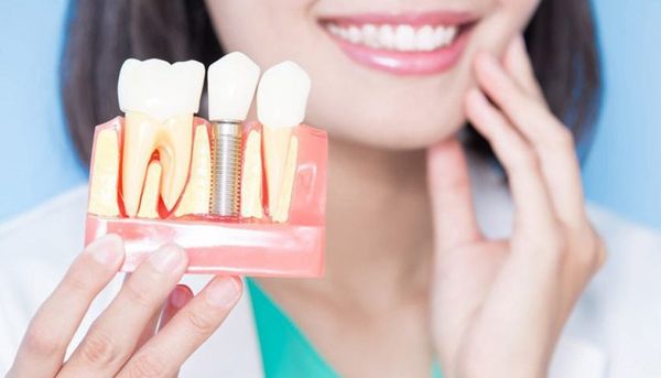 Sau khi trồng răng implant cần lưu ý gì?