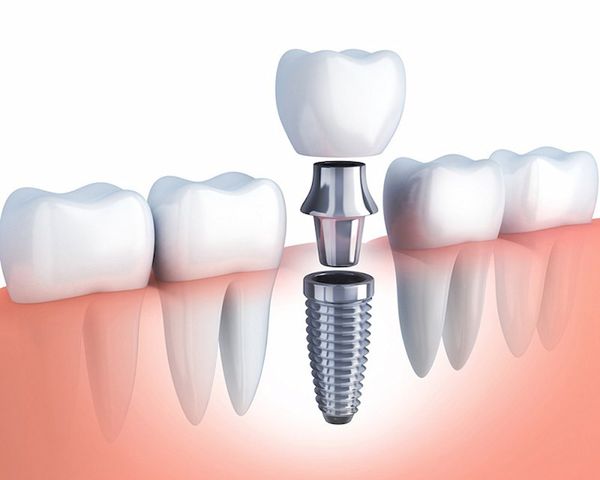 Răng implant loại nào tốt