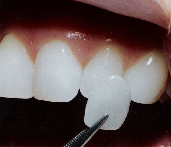 Những nguyên nhân gây hôi miệng sau khi bọc răng sứ