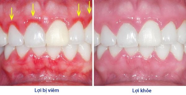 viêm lợi viêm chân răng 2