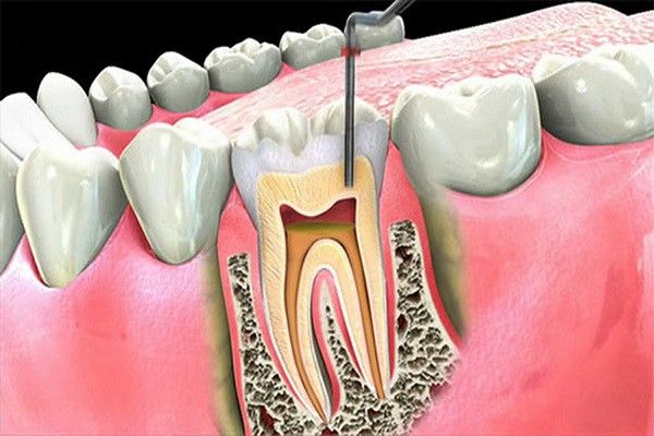 Lấy tủy, trám răng là thủ thuật nha khoa khá phổ biến hiện nay