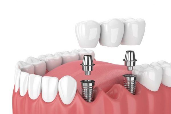 Trồng răng Implant mất bao lâu 2