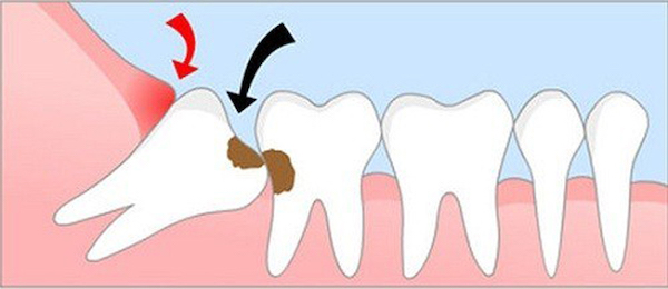 Sâu răng bên cạnh (sâu răng số 7)