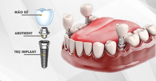 Cấy ghép implant là gì? 