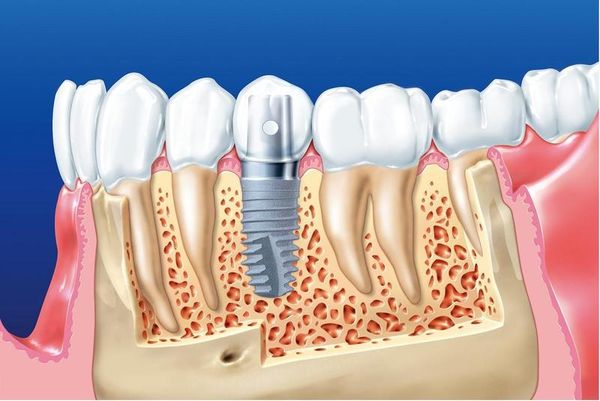 Dịch vụ cấy ghép Implant 