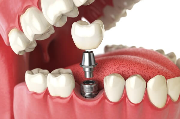 Khái niệm về trồng răng Implant là gì?