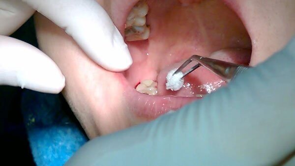 Nhổ răng khôn sai cách sẽ để lại nhiều biến chứng nguy hiểm