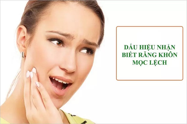 Dấu hiệu răng khôn mọc lệch và những trường hợp cần phải nhổ