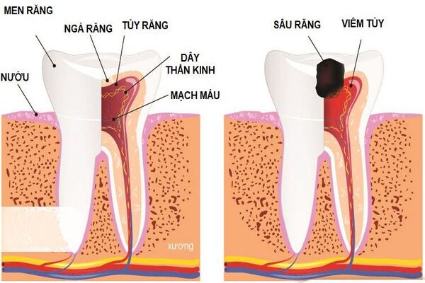 Tủy răng khi xảy ra hiện tượng viêm nhiễm