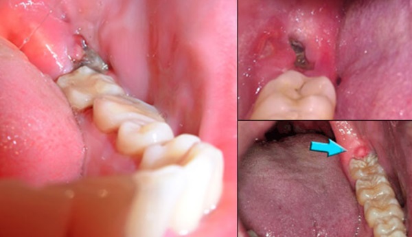 Răng khôn mọc lệch lạc gây ra tình trạng đau nhức, khó chịu