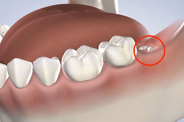 Việc nhổ răng khôn có nguy hiểm không?