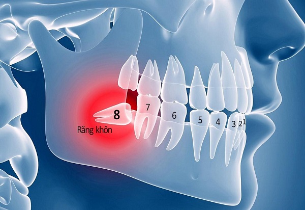 Răng khôn mọc khi nào? 