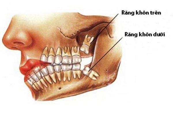 Nhổ răng khôn trên, dưới có nên?