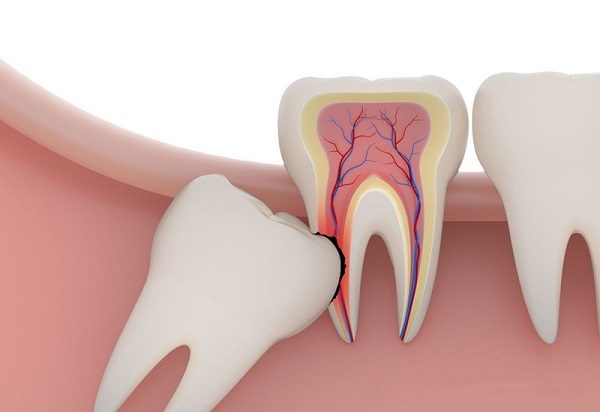 Nhổ răng số 8 sẽ gây ra biến chứng gì?