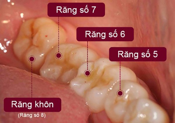 Mô hình răng khôn - răng khôn là răng số mấy?