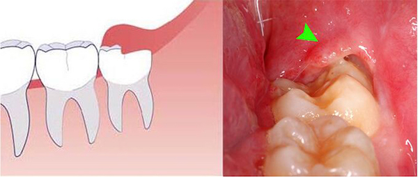 Răng khôn trong trường hợp mọc ngầm có thể gây viêm nhiễm