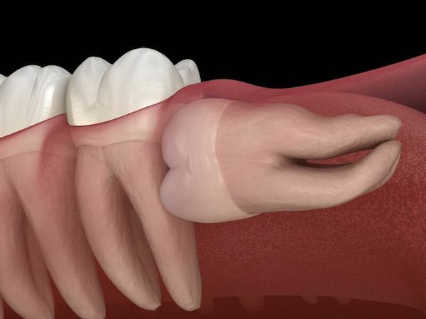 Răng khôn mọc gây ảnh hưởng không tốt tới răng bên cạnh