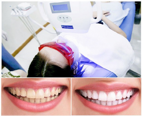 Tẩy trắng răng tốt nhất hiện nay bằng Laser Whitening